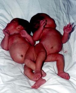 連體嬰兒 連體嬰兒