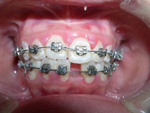 自鎖托槽牙齒矯正 自鎖托槽牙齒矯正