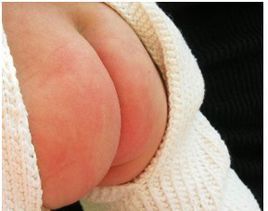 尿布皮炎 尿布皮炎