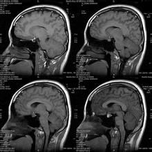 垂體微腺瘤 垂體微腺瘤