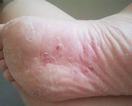 糜爛型腳氣 糜爛型腳氣