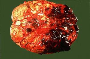 珠網膜下腔出血