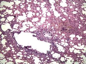 Α1抗胰蛋白酶缺乏性肝病