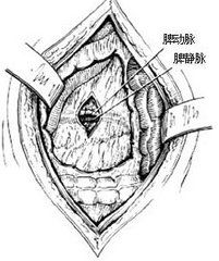 小兒脾外傷 小兒脾外傷