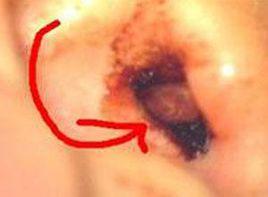 耳道流血 耳道流血