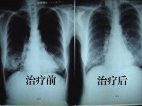 結核性盆腔炎