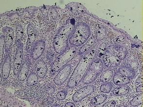 結腸黑變病 結腸黑變病