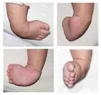 馬蹄足內翻