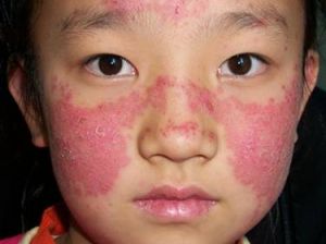 藥物性狼瘡 藥物性狼瘡