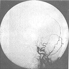 顱內肉芽腫性動脈炎