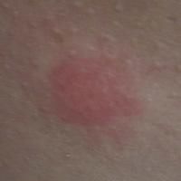 亞急性結節性遊走性脂膜炎