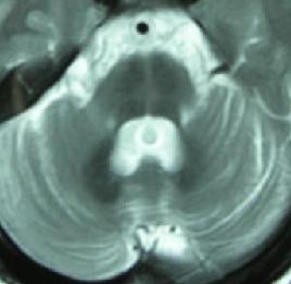 肌萎縮性側索硬化症