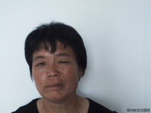 面肌萎縮 面肌萎縮