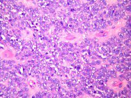 抗Jo-1抗體陽性 抗Jo-1抗體陽性