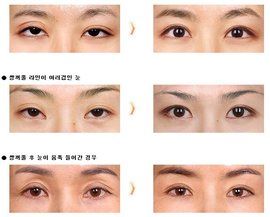 雙眼皮修復手術 雙眼皮修復手術