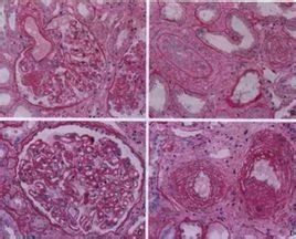 血肌酐高 血肌酐高