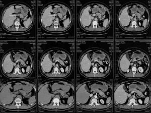 胰腺真性囊腫 胰腺真性囊腫