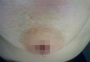 乳頭溢液
