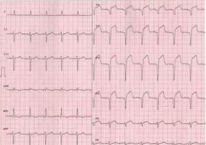 舒張早期奔馬律