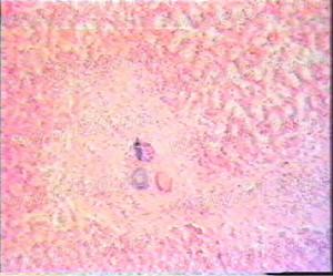 急性細菌性痢疾