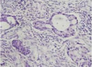 肺腺鱗癌 肺腺鱗癌