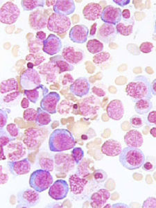 巨幼細胞貧血 巨幼細胞貧血