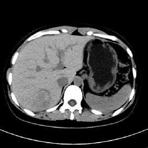 肝臟錯構瘤 肝臟錯構瘤