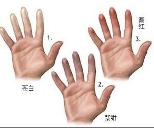 雷諾氏症 雷諾氏症