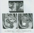 （圖）卵巢肌肉來源腫瘤