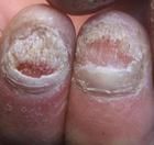 灰指甲症狀 灰指甲症狀