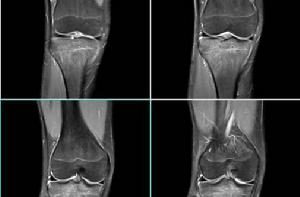 骨髓水腫 骨髓水腫