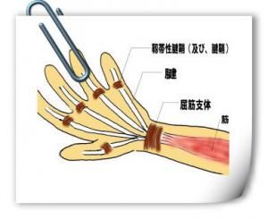 腱鞘炎