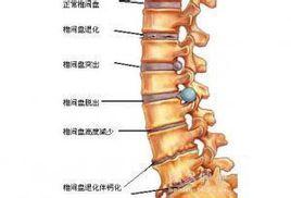 腰椎失穩 腰椎失穩