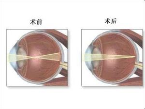 角膜屈光手術 角膜屈光手術