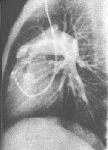 先天性肺動脈狹窄 先天性肺動脈狹窄