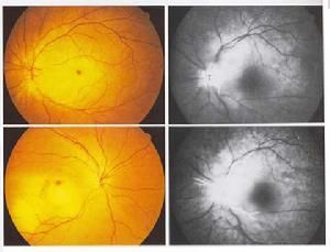 視網膜毛細血管前小動脈阻塞