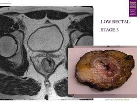 低位直腸癌 低位直腸癌