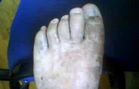 乾性腳氣病 乾性腳氣病