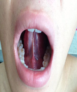 舌系帶