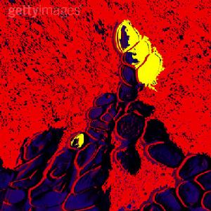 遺傳性球形細胞增多症