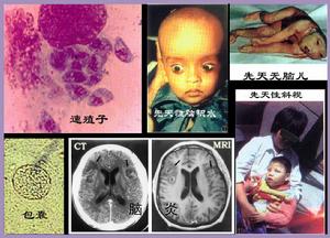 新生兒巨細胞病毒感染