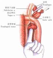 示意圖6:掏出食管牽引線，將食管向上頂出