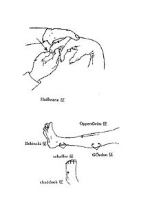 病理反射 病理反射