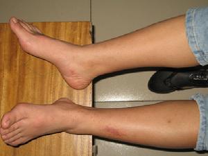 過敏性紫癜綜合徵