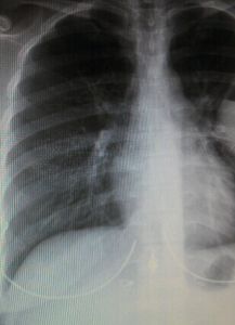 肺囊腫