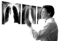 肺組織細胞增生症