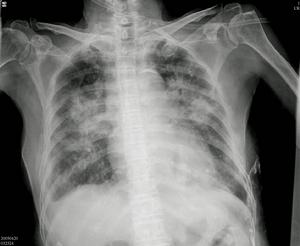 自體瓣膜心內膜炎