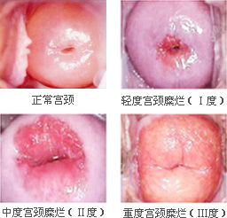 宮頸糜爛程度