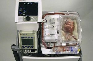 保存液為患者移植死了的心臟