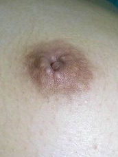 乳頭內陷矯正術 乳頭內陷矯正術